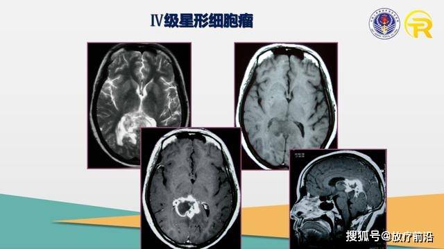 胶质瘤最新治疗手段